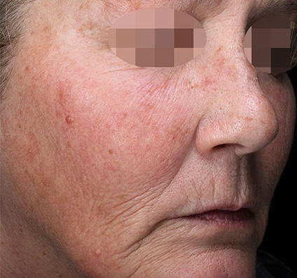 Skin Resurfacing