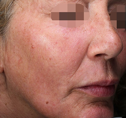 before and after Alma skin resurfacing treatment