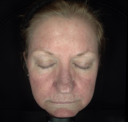 Courtesy of Jeffrey Hsu, MD, FAAD