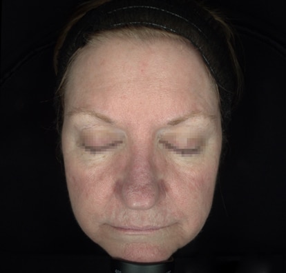 Alma IQ Hsu Case3 Post